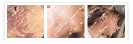 comparison before-after applying EUF is obviously  improving damaged skin